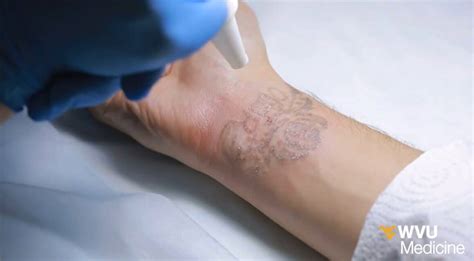 picosure tattoo removal near me